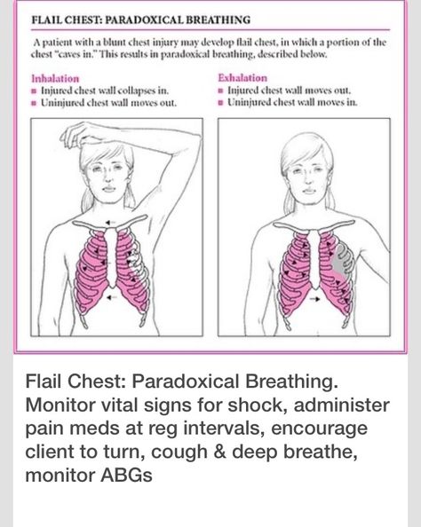 Flail chest Chest Physiotherapy Nursing, Flail Chest Nursing, Flail Chest, Emt Life, Nursing School Studying Cheat Sheets, Emt Study, Nurse Skills, Nursing Cheat Sheet, Nursing 101