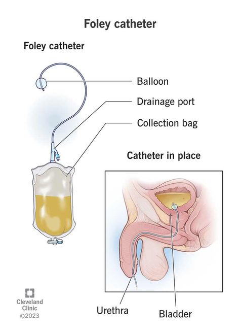 What Is a Foley Catheter? Foley Catheter Nursing, Foley Catheter Insertion, Catheter Insertion, Er Tech, Foley Catheter, Medical School Essentials, Cleveland Clinic, Future Nurse, Elderly Care