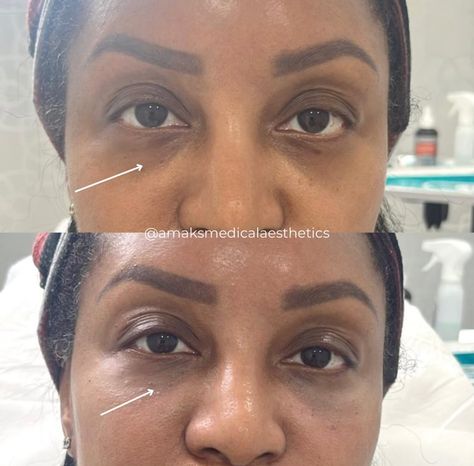 With our expert tear trough correction using premium fillers, you can enjoy an instant transformation:

🌟 Immediate Results
💧 Brighter, Youthful Eyes
✨ Rested & Refreshed Appearance
🚫 No More Hollow Under Eyes

📲 (917) 701-0253 
📞 (585)441-3838 Hollow Under Eyes, Eye Filler, Under Eye Fillers, Tear Trough, Under Eyes, No More