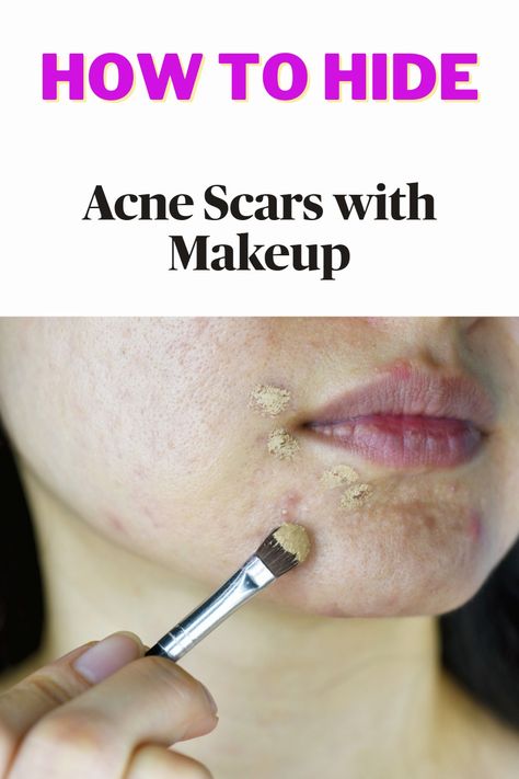 How To Cover Pimples, Scar On Forehead, Covering Acne, Acne Scaring, Facial Scars, Pimples Under The Skin, Makeup Coverage, Pimple Scars, Rid Of Blackheads