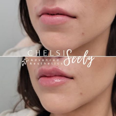 Lip injections 
Lip filler Full Lips, Lip Plumper, Beauty Industry, Lips, Beauty