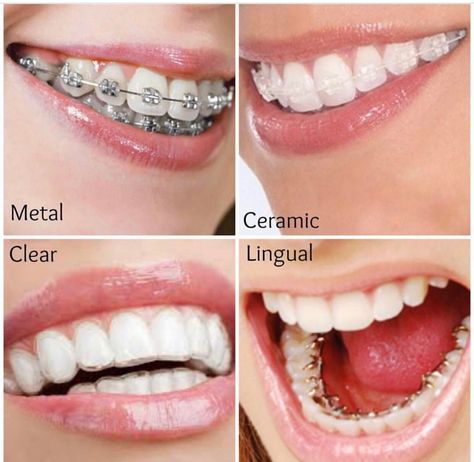 Different Types Of Teeth, Invisible Teeth Braces, Types Of Teeth, Braces Smile, Natural Teeth Whitening Diy, Braces Tips, Getting Braces, Cute Braces, Brace Face