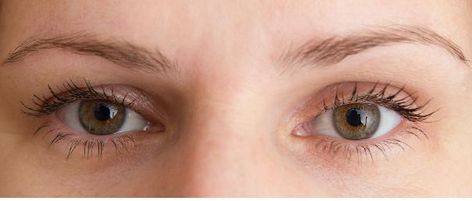 Droopy Eyebrows After Botox?!: Chrysolite Aesthetics : Aesthetic Medical Spa Fix Eyebrows, Aesthetic Medical, Muscle Diseases, Nerve Problems, Drooping Eyelids, How To Do Eyebrows, Droopy Eyelids, Facial Anatomy, Droopy Eyes