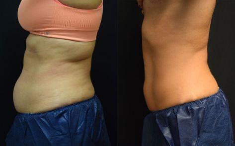 Body Contouring With Coolsculpting Before and After | Dr. Jeffrey Wise Cryo Sculpting Before And After, Emsculpt Before And After, Cool Sculpting Before And After, Glutathione Before And After, Coolsculpting Before And After, Surgical Procedures, Hydra Facial, Cool Sculpting, Before After Photo