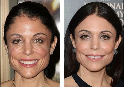 Bethenny Frankel plastic surgery, Bethenny Frankel plastic surgery before after photos, Bethenny Frankel breast augmentation, Bethenny Frankel breast implants, Bethenny Frankel botox Cheek Implants Before And After, Cheek Implants, Plastic Surgery Photos, Hair Implants, Botox Alternative, Cheek Fillers, Facial Fillers, Eyebrow Mascara, Bethenny Frankel