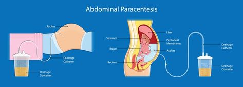 Abdominal Discomfort, Iv Fluids, Low Blood Pressure, Sleep Cycle, Vital Signs, Sleep Problems, Patient Experience, When You Sleep, Medical History