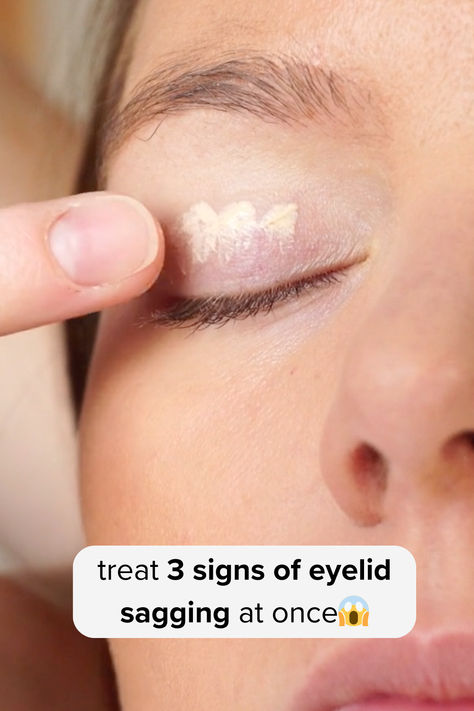 Here's a Great Solution Recommended by Beauty Experts to Smoothen Out & Lift Droopy Eyelids Crepey Eyelids Remedy, Puffy Eyelids How To Get Rid Of, How To Get Rid Of Droopy Eyelids, Crepey Eyelids, Saggy Eyelids, Dark Spots Under Eyes, Sagging Eyelids, Droopy Eyelids, Eyelid Lift