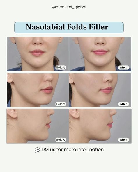 Understanding Nasolabial Folds: Causes and Solutions ⤵️ Nasolabial folds, those smile lines we all recognize, deepen as we age 🕰️ Why do they form?  ▪️ Natural aging reduces facial fat and skin elasticity  ▪️ Frequent smiling and talking contribute to these lines  ▪️ Sun exposure and smoking can accelerate their development How can you soften them? Dermal Fillers like Artecoll: Provides durable, long-lasting smoothing Laser Treatments: Boosts collagen without injections Topical Cr... Plastic Surgery Korea, Facial Fillers, Nasolabial Folds, Smile Lines, Natural Aging, Facial Exercises, Medical Tourism, Breast Augmentation, Anti Aging Treatments