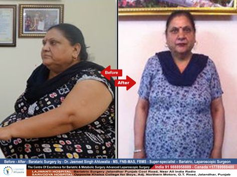 Before, After Shocking 😲 Results Of Bariatric Surgery, Weight Loss Surgery, Dr Jasmeet Singh Ahluwalia Vsg Surgery, Vertical Sleeve Gastrectomy, Sleeve Gastrectomy, Laparoscopic Surgery, Center Of Excellence, Gastric Bypass, Surgery