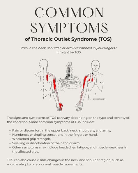 Feeling discomfort in your neck, shoulders, or arms? It could be Thoracic Outlet Syndrome (TOS) 🧨💥 Discover how chiropractic care can help alleviate symptoms and improve your quality of life. From spinal adjustments to postural education, we’ve got you covered 😌🫱🏽‍🫲🏾 SWIPE through to learn more ➡️ ! ____________________________________________ Thoracic Outlet Symptoms, Arm Numbness, Anatomy 101, Stretch Therapy, Thoracic Outlet, Message Therapy, Therapy Exercises, Physical Therapy Exercises, Yoga Anatomy