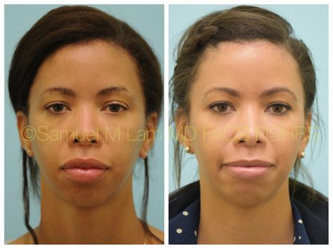 This African-American woman is shown before and 1 year after ethnic lip reduction of both her top and bottom lips. Lip Reduction Before After, Lip Reduction, Forehead Reduction, Bottom Lip, Nose Job, Upper Lip, American Woman, African American Women, Surgery