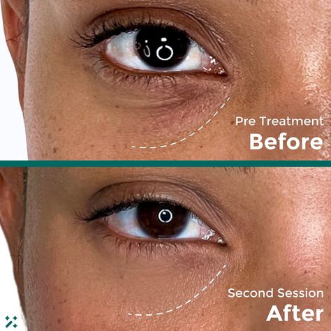 Put down the eye cream, babe! Restores lost volume & creates a more balanced facial symmetry with PRF 💉Stimulates new collagen ✨ Enhances regrowth of new healthy skin 🧚🏻⁠ # Under eye filler before and after Dark circles under the eyes remedies Under eye fillers Under eye wrinkles Bags under eyes remedy Face fillers Fillers before and after Eye bags remedy Vaseline under eyes How to get rid of eye bags Eye bags aesthetic Dark circles How to get rid of dark circles under eye Eye Wrinkles Before And After, Filler Under Eyes Before And After, Eye Bags Aesthetic, Vaseline Under Eyes, Eye Bags Remedy, Dark Circles Under The Eyes Remedies, Under Eye Filler, Undereye Bags Remedy, Get Rid Of Eye Bags