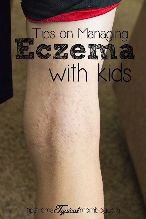 Tips on Managing Eczema with Kids. 5 Great tips on helping your kids eczema outbreaks. Find out what products and methods I use. #sponsored #AveenoEczemaTherapy Calendula Benefits, Coconut Benefits, Kombucha Tea, Insect Bites, Kids Health, What’s Going On, Fatty Acids, Home Remedies, Health Benefits