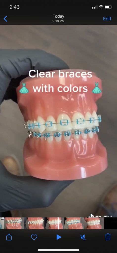 Metal Braces Before And After, Clear Brackets With Colored Bands, Ceramic Braces With Colored Bands, Braces Pink Bands, Ceramic Braces Color Bands, Clear Braces With Color Bands, The Braces Guy, Guy Types, Braces Guy