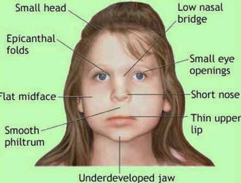 Living with Fetal Alcohol Syndrome is more than just living with these common features... they also suffer from emotional problems, hearing disorders, memory problems, motor skill issues, learning disabilities, and speech impediments for the rest of their lives. Living with it is like being forced to serve out a lifelong prison sentence for a crime your mother committed and you'll have no chance for parole... Prenatal Development, Fetal Alcohol Spectrum Disorder, Fetal Alcohol, Facial Anatomy, Ob Nursing, Genetic Disorders, Spectrum Disorder, Speech Language Pathology, Learning Disabilities