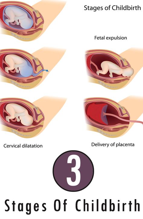 3 Stages Of Childbirth: Here we explain in detail the 3 stages of childbirth and what happens during those stages. #Pregnancy Lamaze Breathing, Ivf Procedure, Nursing Classes, Stages Of Labor, 1st Trimester, Baby Club, Labor Delivery, Mom Junction, Nursing Care