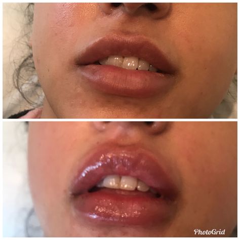 Lip Fillers Before And After 1ml, Hyaluron Pen Lip Filler Mapping, Lip Filler Before And After 1ml Juvederm, 1ml Lip Filler, Lip Filler M Shaped Lips, Lip Filler 1 Ml, .5ml Vs 1ml Lip Filler, 1.5 Ml Lip Filler, Face Fillers