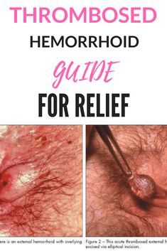 External Hemmoroids, Thrombosed Hemorrhoid, Hemorrhoid Remedies, Hemorrhoid Relief, Home Remedies, Natural Remedies, The Globe, Healing, Thing 1