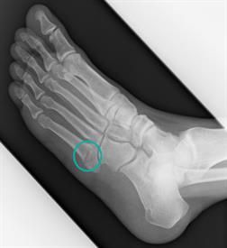 5th Metatarsal Fracture Surgery Procedure & Recovery Jones Fracture, Metatarsal Fracture, Bone Healing, Foot Anatomy, Bone Grafting, Kt Tape, Garden Growing, After Surgery, The Bone