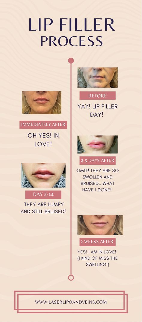 Laser Lipo, Lip Filler, Make A Decision, Lip Fillers, Important Information, Look Younger, What Type, That Look, Lips