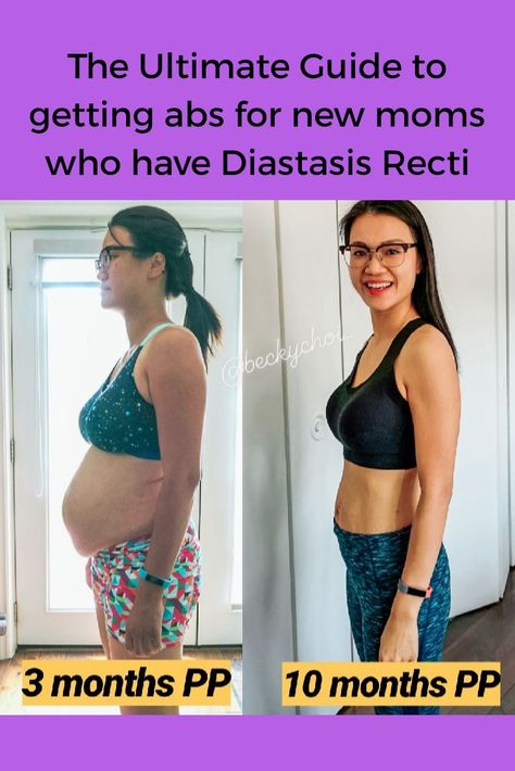 This is a before and after picture when I was 3 months and 10months postpartum with my second child. In this post, I talked how to heal and get abs again with exercises. I talked about the symptoms having diastasis recti and how to correctly fix it with. Pin it  and then click to read it!  #diastasisrecti #abdominalseparation Diastis Recti Before And After, 3 Months Postpartum, Diastasis Recti Before After, Diastis Recti, Diastasis Recti Repair, What Is Diastasis Recti, Mom Tummy, Healing Diastasis Recti, Mommy Pooch