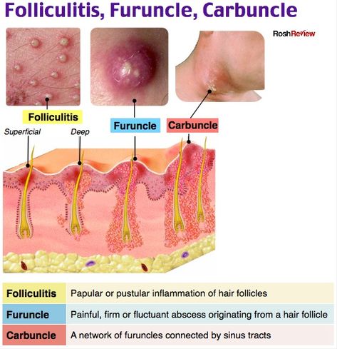 PANCE and PANRE Review Dermatology Study Notes, Burn Wound Care, Doctor Of Nursing Practice, Medical Pins, Nursing Study Guide, Nursing School Motivation, Skin Facts, Medical Pictures, Basic Anatomy And Physiology