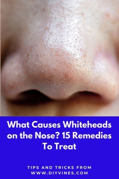 Whiteheads on nose are caused by oily skin, open skin pores and dirt. There are several whiteheads on nose removal remedies available. In this article I am sharing simple and easy home remedies to remove whiteheads on nose. #whiteheads #whiteheadsonnose #whiteheadsremovalremedies #howtoremovewhiteheads #beautytips #skincare Get Rid Of White Heads On Nose, Oily Nose Remedy, Strawberry Nose Remedy, How To Get Rid Of Strawberry Nose, Nose White Head Removal, How To Get Rid Of White Heads On Nose, How To Remove Whiteheads From Nose, White Heads Removal Remedies, Whiteheads Removal Remedies