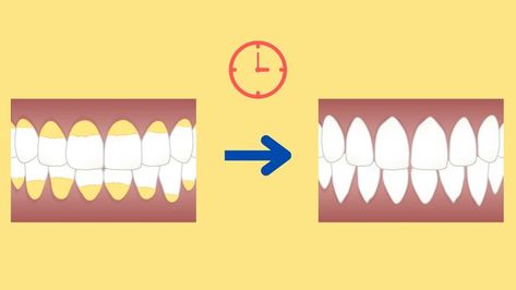 Teeth stains are not permanent. The time it takes to remove them varies from person to person. Fortunately, some options can help you get rid of them instantly. Removing Lipstick Stains, Diy Natural Detergent, Remove Yellow Stains, Teeth Stain Remover, Coffee Stain Removal, Permanent Lipstick, Dental Cavities, Diy Teething, Wine Stains