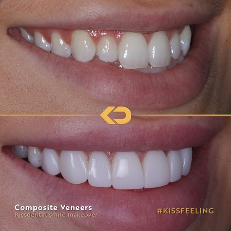 How incredible is this composite veneer makeover?! This patient was looking for a brighter more symmetrical smile. The Dr placed 8 composite veneers to complete the look. Book in for a FREE consultation at any of our clinics: 📍Manchester City centre 📍Flixton 📍Altrincham 📍Knutsford 📍Alderley Edge 📍Liverpool Head to kissdental.co.uk to get booked in Dental Cover, Composite Bonding, Cosmetic Dentistry Veneers, Dental Composite, Composite Veneers, Alderley Edge, Dental Fillings, Aesthetic Dentistry, Dental Tourism