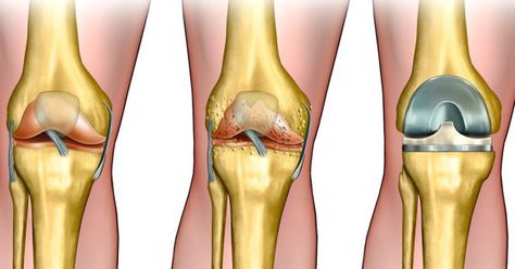 Thanks to this Israeli company, knee replacement surgery may soon be a thing of the past. Acl Reconstruction Surgery, Knee Ligaments, Knee Problem, Acl Tear, Knee Replacement Surgery, Knee Exercises, Orthopedic Surgery, Knee Pain Relief, Knee Surgery