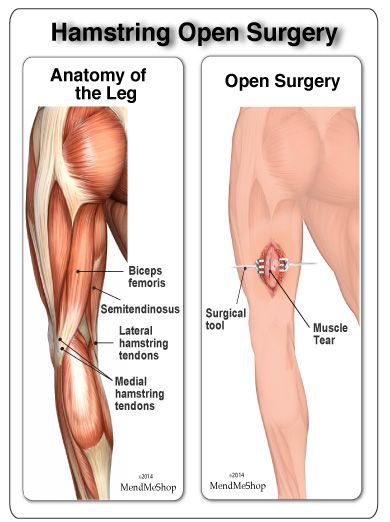 Hamstring Surgery Hamstring Rehab, Torn Hamstring, Hip Injury, Muscle Tear, Hamstring Injury, Fake Tears, Hamstring Muscles, Hip Injuries, Soft Tissue Injury