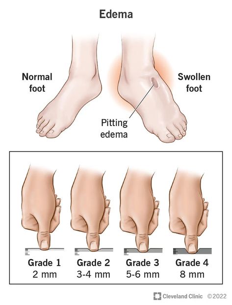 Who needs a foot bath massager? Edema---People with edema have poor blood circulation and the feet or legs are swollen usually. If you have edema, it is better to do some foot bath massage on your feet, hence the blood circulation will be improved. On that note, the condition of the feet and legs will get better. #edema #massage #massager #footspa Edema Causes, Lymph Glands, Venous Insufficiency, Fluid Retention, Hand Massage, Cleveland Clinic, Water Retention, Body Anatomy, Poor Posture