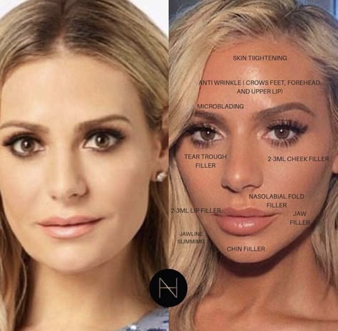 #plasticsurgery #cosmeticsurgery #tipsandtricks #seanabeauty Facial Balancing, Extreme Plastic Surgery, Face Fillers, Botox Lips, Cheek Fillers, Facial Surgery, Facial Fillers, Facial Contouring, Lip Augmentation