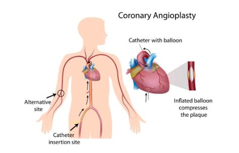 Coronary angioplasty, also known as percutaneous coronary intervention, is a process used to open clogged heart arteries. A tiny balloon catheter is placed during an angioplasty procedure to assist widen a blood artery that has become narrowed and enhance blood flow to the heart. Along with angioplasty, a narrow wire mesh tube known as a stent is typically implanted. The stent keeps the artery open and reduces the possibility of further arterial narrowing. Coronary Circulation, Catheter Insertion, Heart Arteries, Chest Discomfort, Heart Valves, Heart Function, Heart Muscle, Coronary Arteries, Medical Help