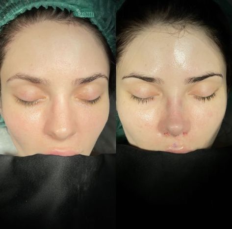 Turkey Nose Job Before And After, Round Face Nose Job, Button Nose Rhinoplasty, Big Nose Rhinoplasty, Bulbous Nose Job, Natural Nose Job Before After, Nose Job Inspiration Front View, Nose Job Inspo Front View, Rhinoplasty Front View