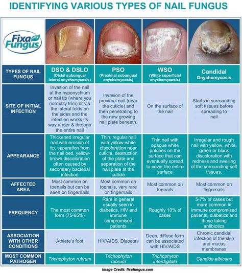 Nail Fungus Nail Disorders, Toenail Fungal Infection, Nail Remedies, Fingernail Fungus, Toenail Fungus Remedies, Nail Problems, Nail Infection, Nail Fungus Remedy, Fungal Nail