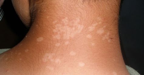 Hypopigmentation Tinea Versicolor, Fungal Infection Skin, Organic Skin Care Routine, Dark Spots On Skin, Fungal Infection, Skin Remedies, Skin Diseases, Skin Care Remedies, Natural Home Remedies