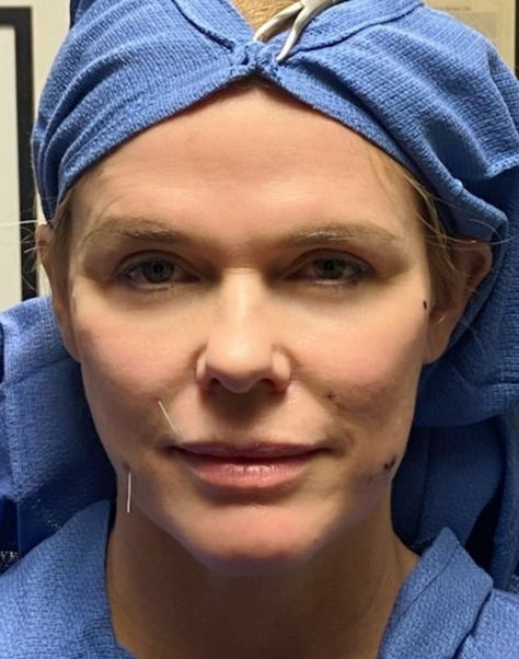 Thread Lifts: What The Pros Want You To Know About The Trendy Procedure Facial Thread Lift, Pdo Thread Lift Before And After, Thread Lift Face, Cheek Fat, Thread Lift, Nasolabial Folds, Cosmetic Treatments, Scar Tissue, Double Chin