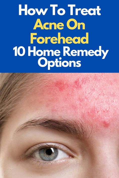 How To Treat Acne On Forehead: 10 Home Remedy Options Acne On Forehead, Forehead Acne, Dark Eye Circles, Home Remedies For Acne, How To Get Rid Of Pimples, Acne Causes, Treat Acne, The Nose, How To Treat Acne