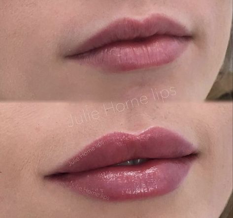 Dermal Fillers Lips, Derma Fillers, Lips Inspiration, Botox Lips, Facial Contouring, Facial Aesthetics, Lip Filler, Permanent Makeup Eyebrows, Botox Fillers