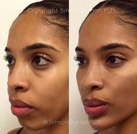 This 5-Minute Procedure Gives You the Same Feature That Successful People Have- Cosmopolitan.com Face Injections, Chin Filler, Cheek Implants, Cheek Lift, Chin Augmentation, Chin Implant, Face Fillers, Botox Before And After, Cheek Fillers