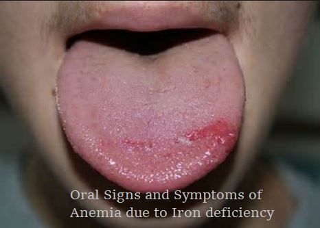 Anemia due to Iron Deficiency which i has many Oral signs and symptoms ... Burning Mouth, Burning Tongue, Remedies For Dry Mouth, Tongue Health, Dry Mouth, Integrative Health, Nursing Tips, Natural Home Remedies, Natural Treatments