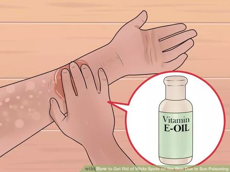 Image titled Get Rid of White Spots on the Skin Due to Sun Poisoning Step 1 White Skin Spots, Sun Poisoning, Sun Spots On Skin, Combination Skin Makeup, Face Cleanser Brush, Antifungal Cream, How To Do Eyeliner, Spots On Legs, Nail Infection