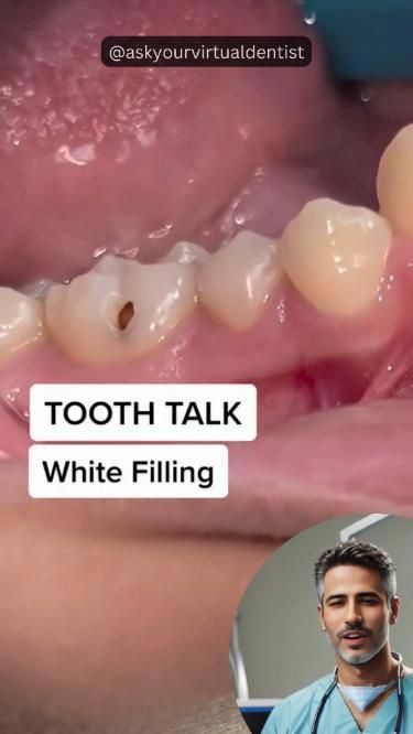 This dental video walks you through what to expect when getting a white composite resin filling. See how the dentist drills out decay, applies a blue etching material, bonds the tooth, shapes the malleable filling, and hardens it with a special light. #whitefillings #compositefillings #resinfillings #cavityfillings #whitefillings #dentalvideo #resinfilling #toothbonding #dentaldecay #drillofdecay #etchingmaterial #toothshaping #dentalprocedure #dentistwalk #WhoOralCare Teeth Bonding, Composite Fillings, Dental Decay, Dental Videos, Dental Fillings, Dental School, How To Prevent Cavities, Oral Care Routine, Gum Care