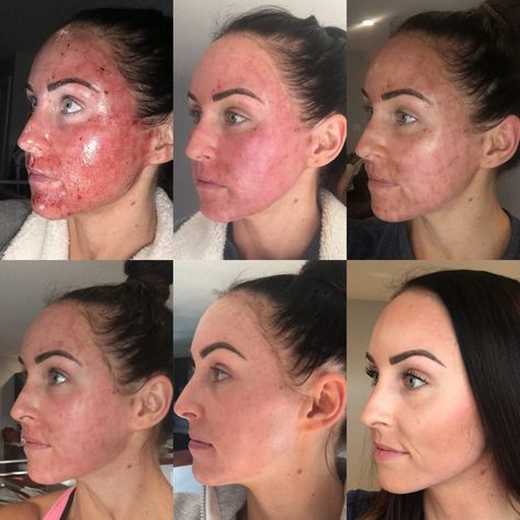 PaleOMG - My Experience w/ Profractional & Why I Keep Going Back Profractional Laser, Prp Hair, Laser Skin Resurfacing, Beauty Procedures, Laser Resurfacing, Severe Acne, Skin Resurfacing, Smile Makeover, Laser Skin