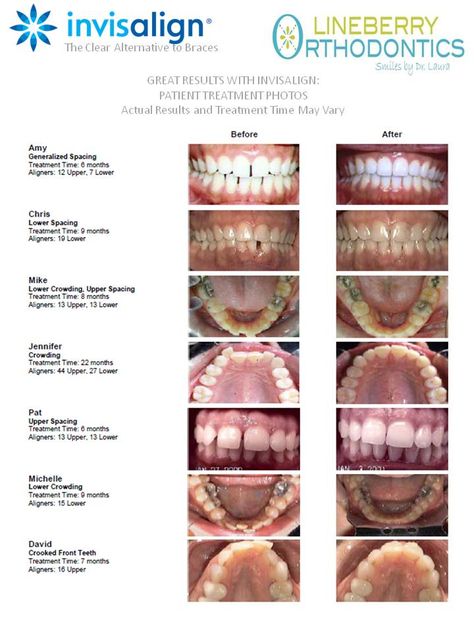 Before and After with Invisalign Invisalign Marketing, Invisalign Before And After, Invisalign Aesthetic, Teeth Goals, Orthodontic Marketing, Braces Journey, Orthodontics Marketing, Cosmetic Dentistry Veneers, Dental Assistant Study