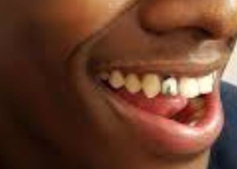 A grade 12 pupil, who has a silver tooth was expelled from Mount Ayliff Comprehensive High School in the Eastern Cape. Silver Tooth, Domestic Worker, Grade 12, First Doctor, Eastern Cape, School Quotes, Going Back To School, High School, Cape