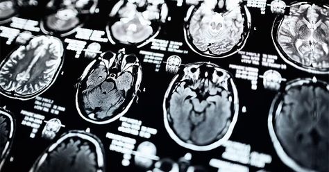 Researchers say MRI scans can help identify brain atrophy in people with Parkinson's and help predict the progression of the disease as well as what treatments might be most effective Muscle Weakness And Fatigue, Vitamin B Deficiency, Deep Brain Stimulation, Mri Scan, Boost Memory, Autoimmune Disorder, Medical News, Medical Information, Clinical Trials