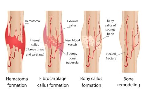 Bone Healing Process, Stages Of Healing, Fracture Healing, Skeleton Human, Bone Healing, Types Of Bones, Headache Causes, Hip Fracture, Bone Fracture