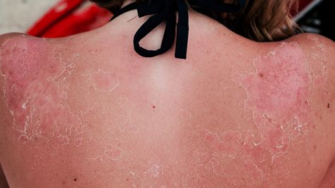 5 Signs You Have Sun Poisoning #Positivity #OrangeLife Sun Poisoning Rash, Sun Poisoning, Protect Yourself, The Pool, Tattoo Quotes, Pool, Sun, Signs, Tattoos